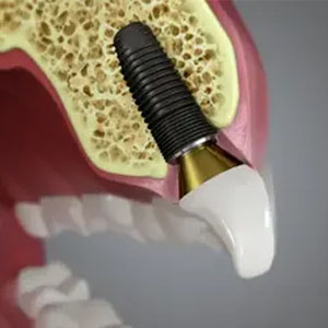 5 Reason To Pick Dental Implants for Missing Teeth