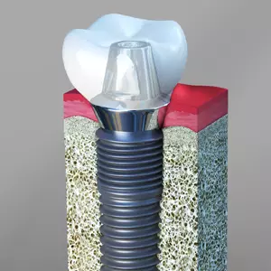 Are Dental Implants Safe in the Long Run? | Midland, TX