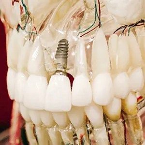 Dental Implants: A Solution for Tooth Loss | Midland, TX