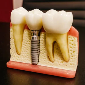 What to Expect During Dental Implants Treatment in Midland?