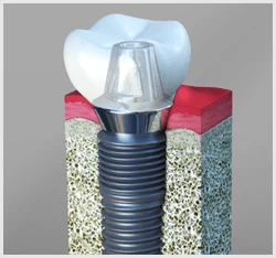 Dental Implants Midland